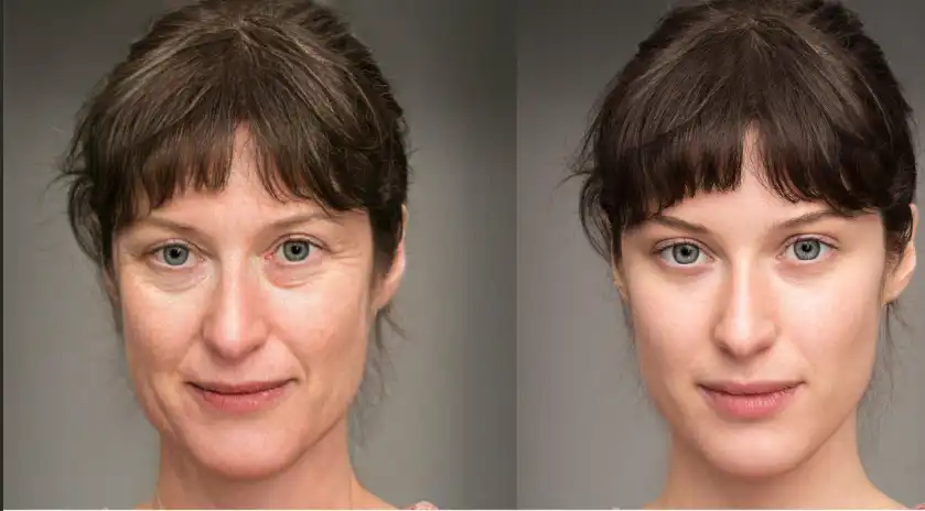 Botox Before and After Eyes